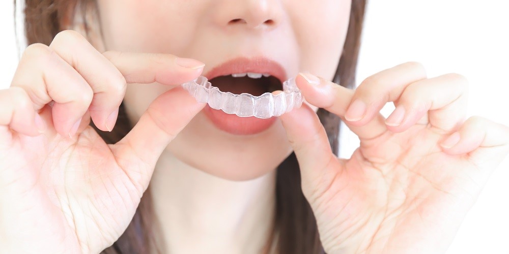 怕痛又愛美？隱形牙套價格、優缺點、費用行情懶人包