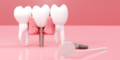 植牙失敗怎麼辦？森釉牙醫教你辨識症狀、原因與補救方式！