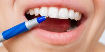 牙齒上為什麼有白點？牙醫帶你了解牙齒鈣化原因與補救方法 