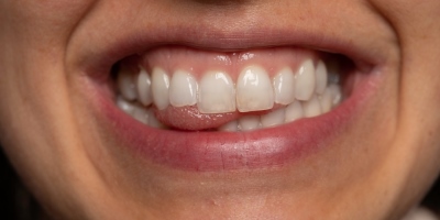 牙齦外露怎麼辦？一篇看懂露齦治療與費用