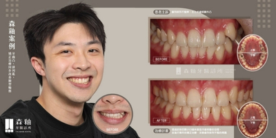 隱適美矯正  虎牙外凸不再是煩惱，矯正同步改善臉型輪廓-1
