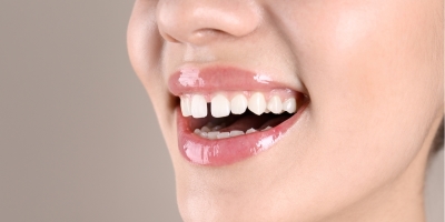 牙縫變大怎麼辦？4大治療解決牙縫大問題 不讓小縫隙成大困擾