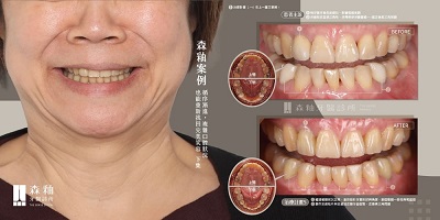 【隱適美矯正結合陶瓷貼片案例】複雜口腔狀況也能重拾自然笑容(1)