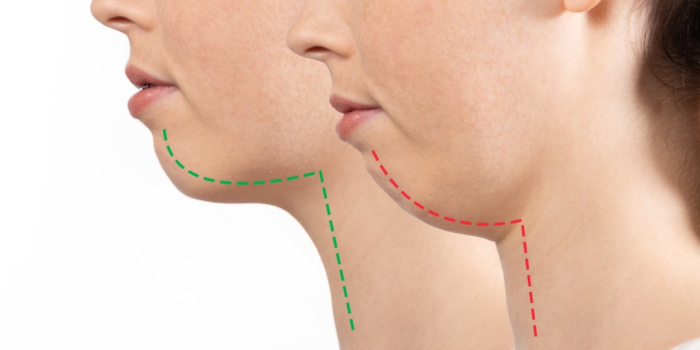 下巴後縮怎麼辦？原因、改善方式、下巴後縮矯正建議一次看懂！