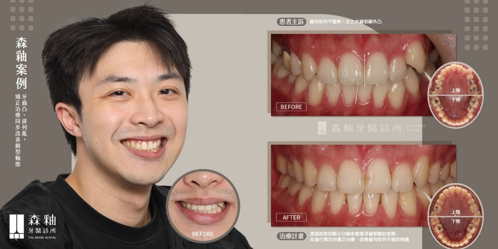 隱適美矯正  虎牙外凸不再是煩惱，矯正同步改善臉型輪廓